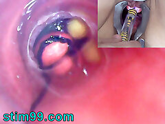 Mature Woman, Peehole Endoscope Camera in Bladder with Plums