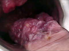 Inwards view of my extreme Prolapse asshole