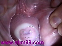 Insertion Nectar in Cervix Pussy Speculum. Cum in Uterus