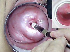 A endoscope japanese camera is inserted in the cervix to watch inwards the uterus.