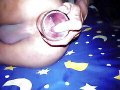 fisting anal gaping and prolapse