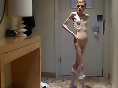 Anorexia Christin showing her Bones & Skinny Skeleton