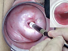 A endoscope japanese camera is slammed in the cervix to observe inside the uterus.