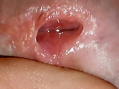 Preparing the damsel for insertion of the tube with the anesthetic serum.
